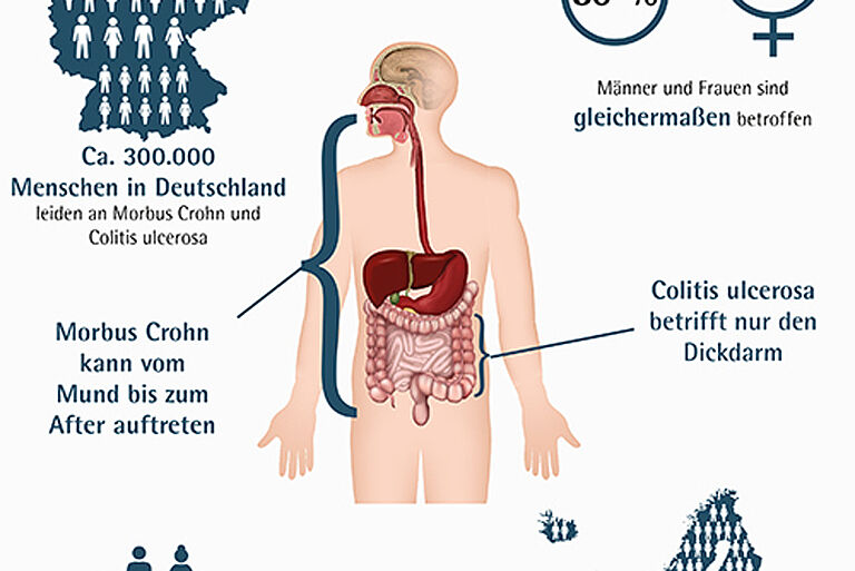 5 Fakten zu Morbus Crohn und Colitis ulcerosa