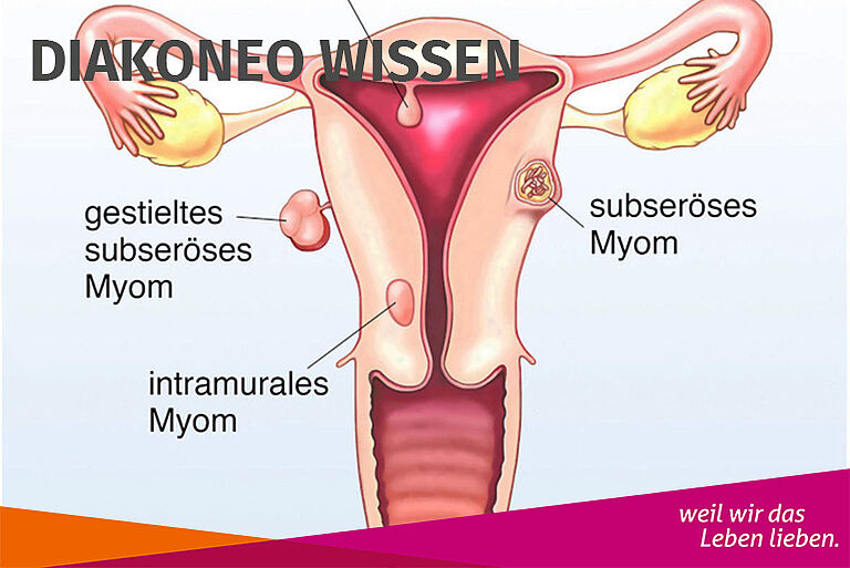Definition Myome an der Gebärmutter
